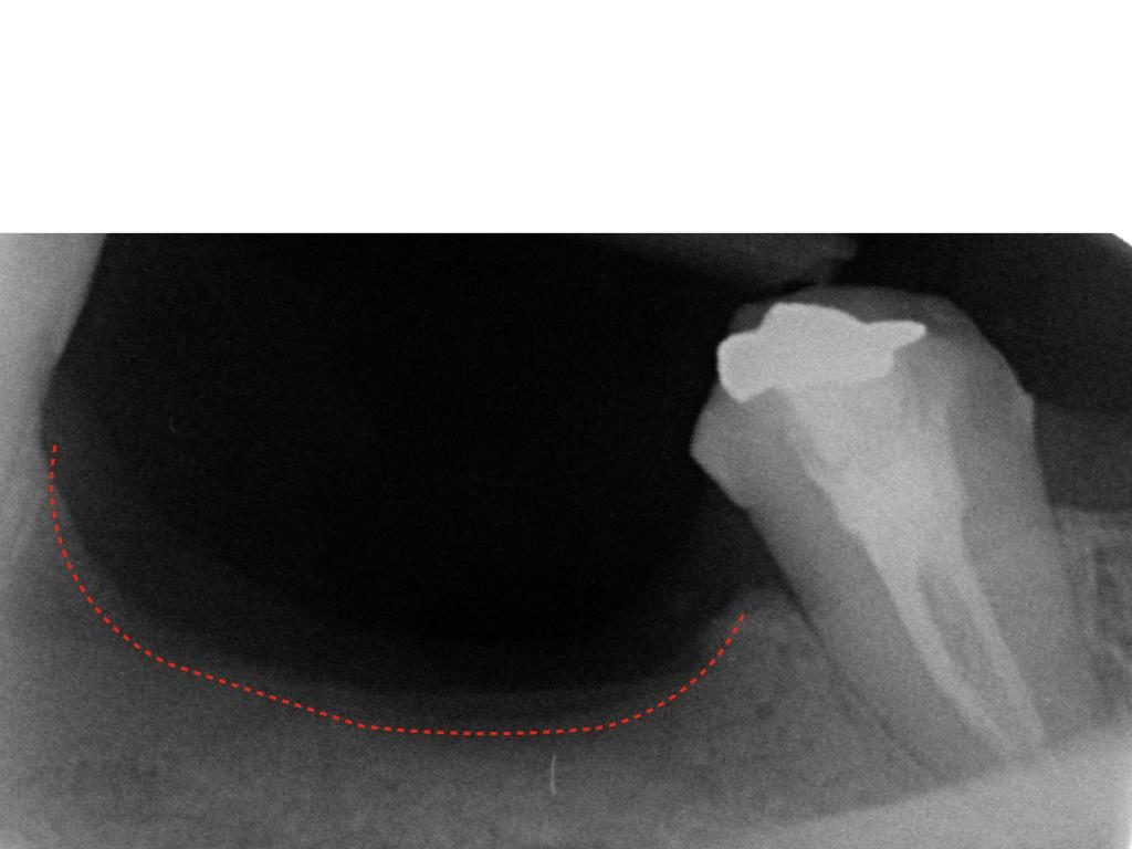 RX prima del rialzo verticale dell'osso mandibolare sul lato sinistro