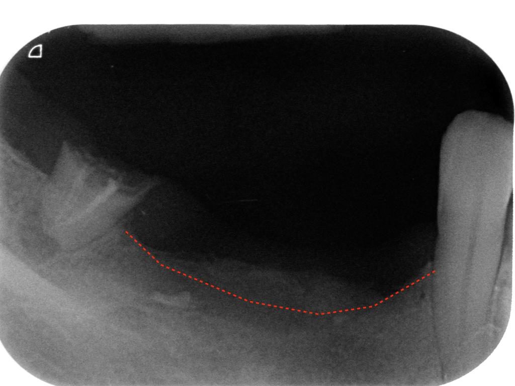 RX prima del rialzo verticale dell'osso mandibolare sul lato destro.