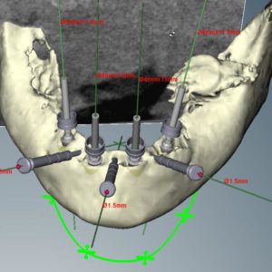 Pianificazione digitale per posizionare virtualmente gli impianti